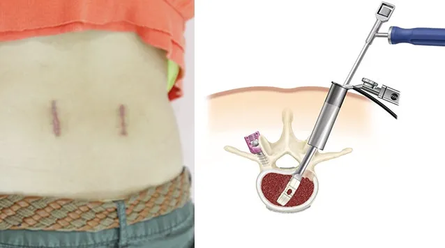 최소침습 요추 유합술 후 흉터와 수술 방식 모식도. 왼쪽은 등 양옆에 남은 두 개의 작은 흉터, 오른쪽은 관 모양 통로로 접근해 케이지를 넣는 모습