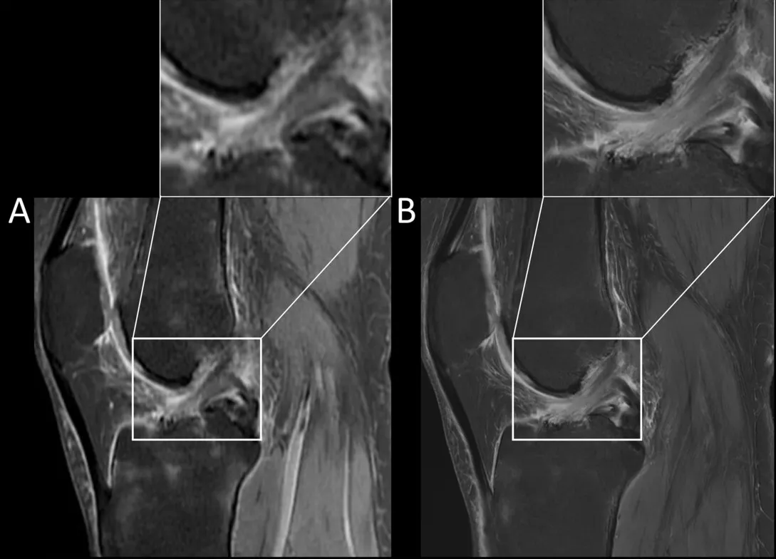 테슬라 세기에 따른 MRI 영상 질 비교. A는 낮은 자기장, B는 3.0T로 촬영한 무릎 인대 부위 영상이며 확대한 부위에서 섬유 결의 선명도 차이가 뚜렷하다