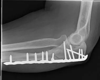 팔꿈치 주두(척골) 분쇄 골절을 금속판과 다수의 나사로 고정한 측면 x-ray