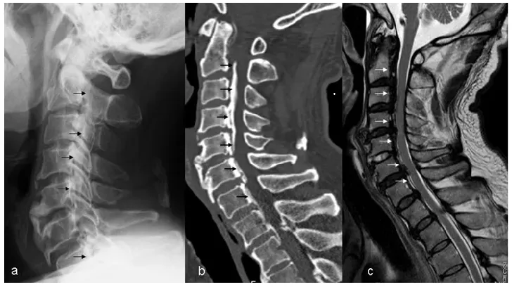 경추 후종인대 골화증의 X-ray, CT, MRI 영상. 화살표가 척추체 뒤를 따라 이어진 골화를 가리키고 있다