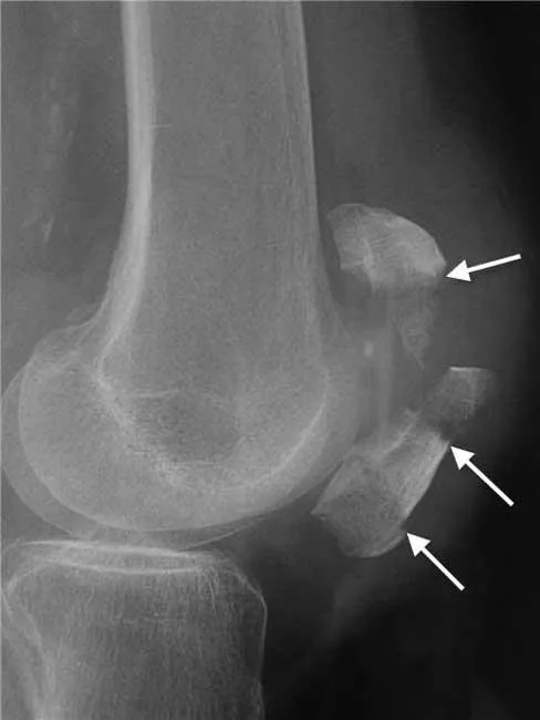 슬개골(무릎뼈) 분쇄 골절 x-ray, 화살표로 표시된 여러 조각으로 부서진 골절편