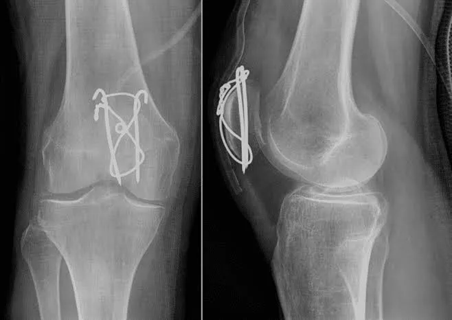 슬개골 골절을 8자 장력 밴드로 고정한 전후면·측면 x-ray