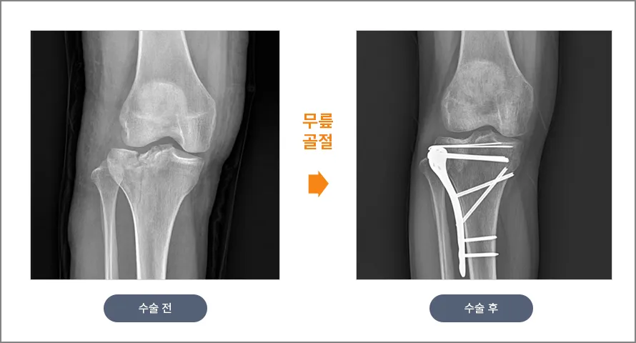 무릎뼈 골절 수술 전후 X-ray. 금속과 나사·핀으로 고정해 관절면을 회복한 모습