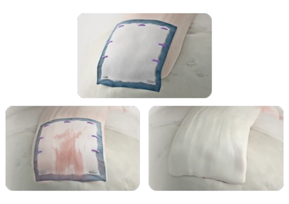 패치가 힘줄로 바뀌는 세 단계. 첫 장면은 힘줄 위에 갓 고정된 흰 패치, 둘째 장면은 패치 안으로 혈관과 조직이 들어와 붉은빛이 비치는 상태, 셋째 장면은 패치가 사라지고 힘줄 자체가 두꺼워진 상태