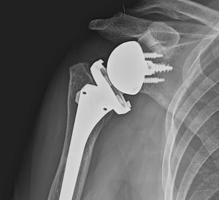역행성 어깨 인공관절 치환술 후 X-ray. 어깨뼈 쪽에 나사 세 개로 고정한 둥근 금속 공이 있고, 위팔뼈 안으로 들어간 긴 금속 기둥 위의 소켓이 공을 받고 있다