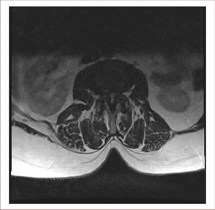 척추관협착증 MRI. 신경이 지나가는 구멍이 거의 막힐 만큼 심하게 좁아진 모습