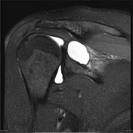 어깨 MRI 관상면 영상. 관절와 위쪽 견갑상절흔 부위에 하얗고 둥근 결절종이 보이는 모습