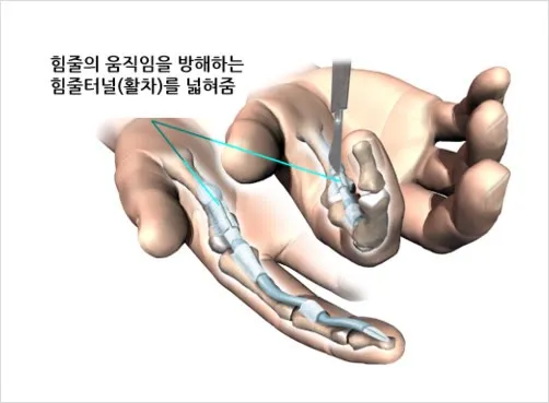 방아쇠수지 수술 모식도. 손바닥 쪽에서 기구를 넣어 손가락 굽힘 힘줄의 움직임을 방해하는 힘줄터널(A1 활차)을 세로로 끊어 넓히는 모습