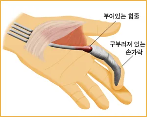 방아쇠수지 모식도. 손가락 굽힘 힘줄이 지나는 A1 활차 부위가 좁아져 힘줄이 걸리는 모습