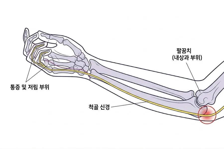 팔꿈치터널증후군 모식도. 팔뼈를 투시한 그림으로, 노란색 척골신경이 팔꿈치 안쪽(내상과 부위)을 지나 손으로 이어진다. 팔꿈치 안쪽에 붉은 원으로 눌리는 지점이 표시되어 있고, 넷째·다섯째 손가락 쪽에 통증 및 저림 부위가 표시되어 있다