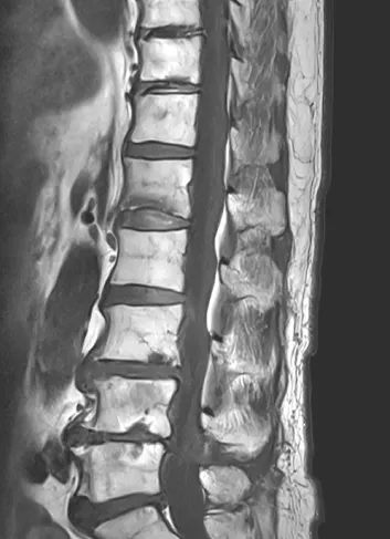 척추 압박골절 MRI. 골절된 척추뼈가 검게 보이는 모습